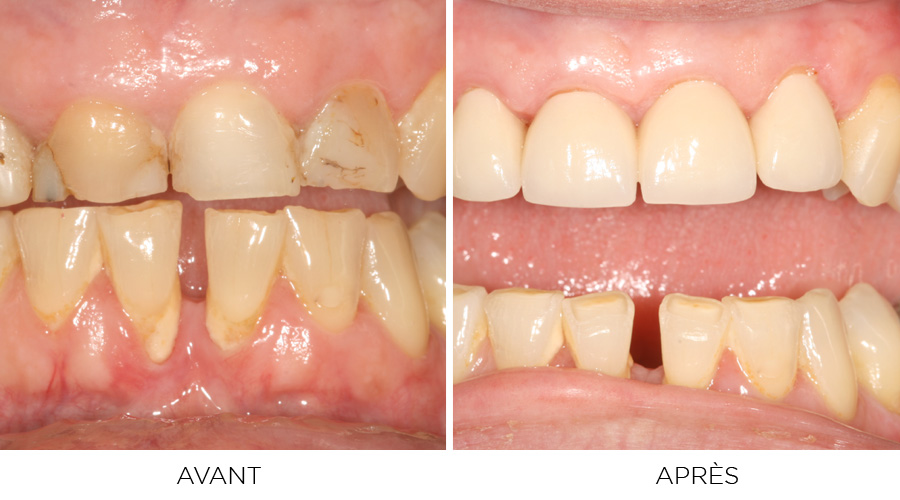 Allongement de couronne clinique