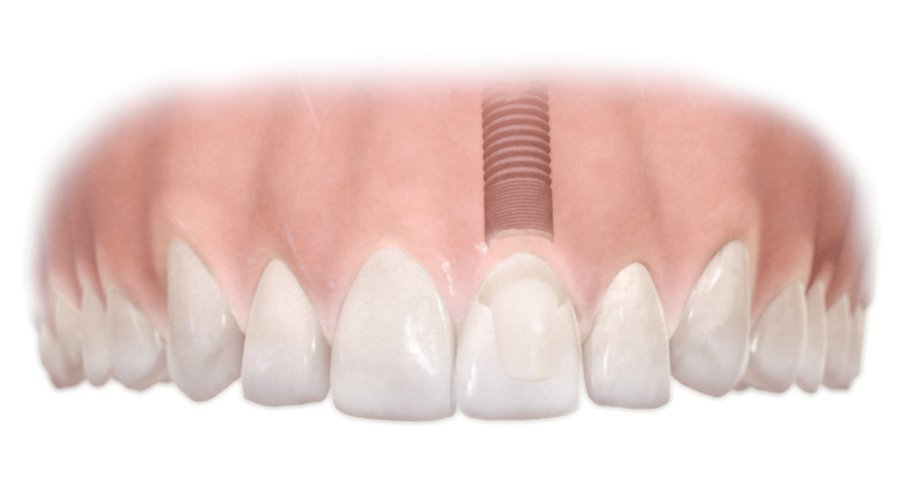 Couronne sur implant