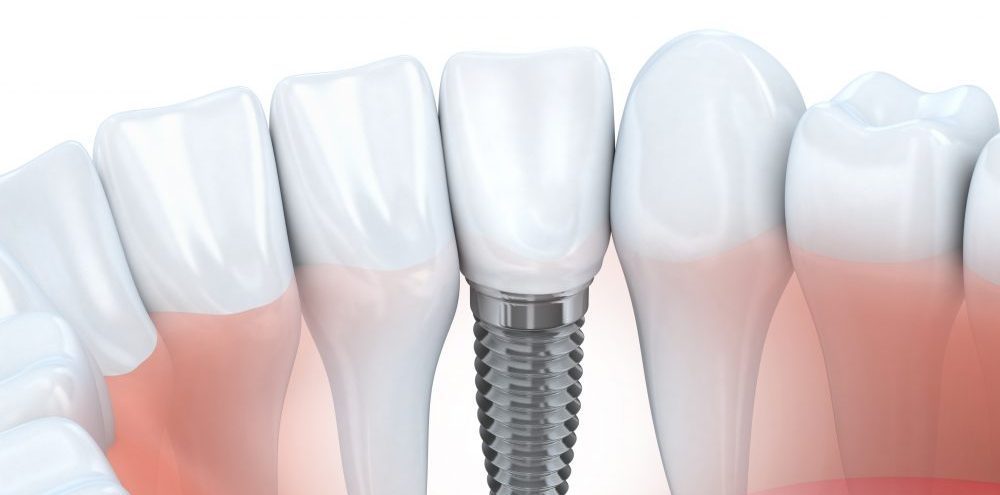 Couronne sur implant centre sante dentaire candiac