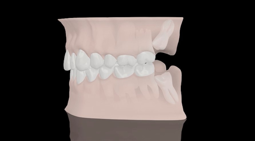 Chirurgie et extraction de dents de sagesse