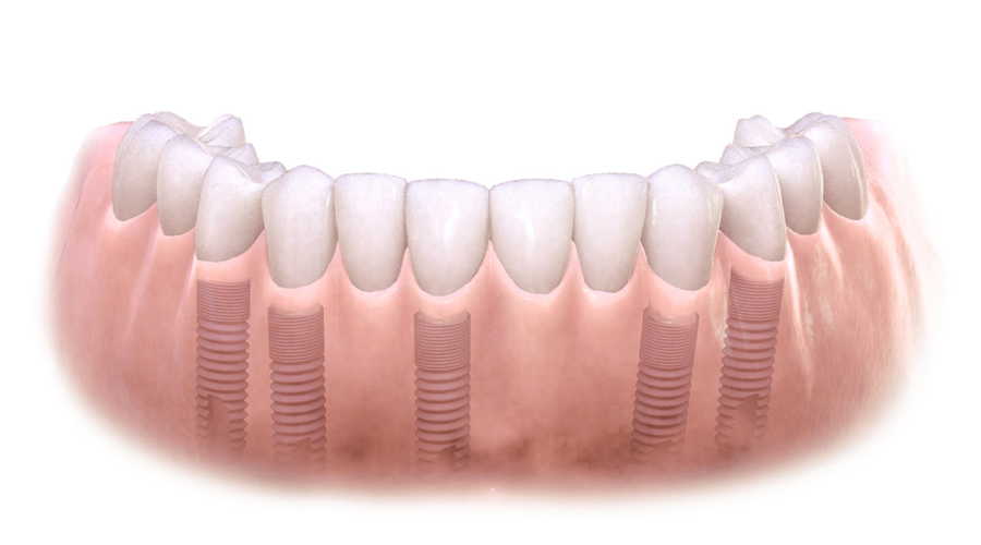 Pont sur implants
