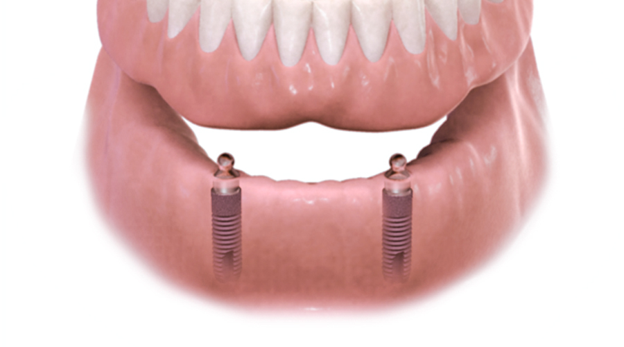 Prothèse sur implants
